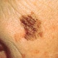 Image for Melanoma