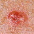 Image for Non-melanoma skin cancer